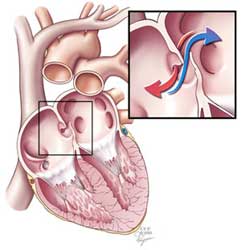 pfo closure migraine study